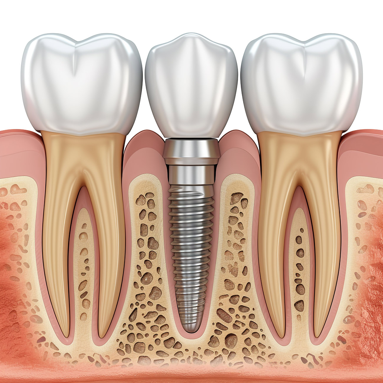 Aktif Dent implant AKTİF DENT www.aktifdent.com.tr info@aktifdent.com.tr 05399280551